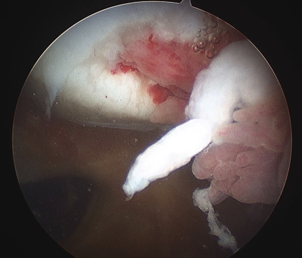 Patella Dislocation Unsalvageable Chondral Lesion